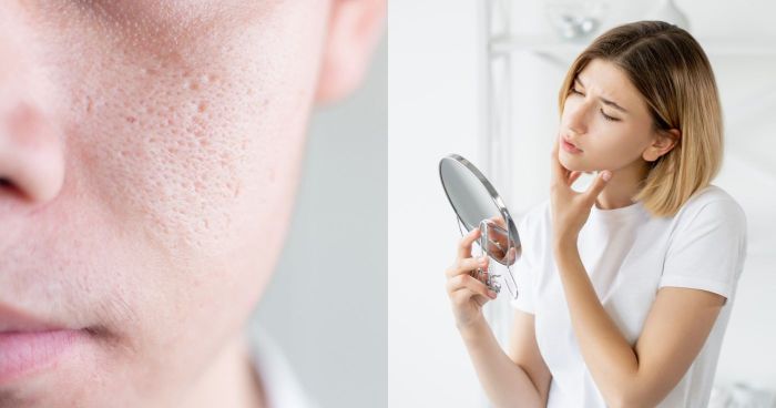 毛孔粗大原因｜毛孔粗大怎麼辦？中醫角度分析毛孔粗大類型+收毛孔方法【專欄】