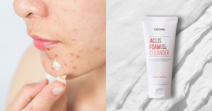 水楊酸產品｜去黑頭粉刺救星！一文了解水楊酸功效及副作用 13款BHA護膚品推薦