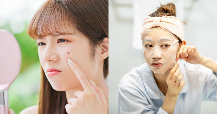 暗瘡面膜推薦｜10款消炎去印暗瘡面膜推介！痘痘肌敷面膜注意事項