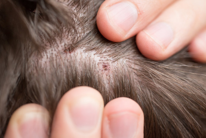 8款頭皮敏感洗頭水推薦！一次過止頭痕/去頭皮/減少頭油及泛紅+拆解頭皮敏感原因